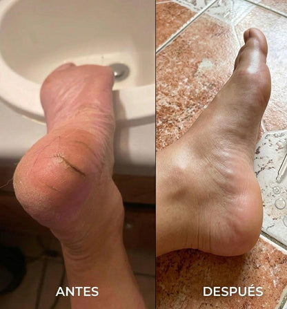 Aceite para Talones – Reparador y Suavizante de Talones Agrietados y Callosidades
