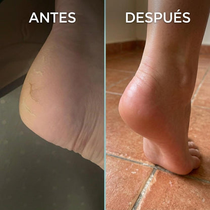Aceite para Talones – Reparador y Suavizante de Talones Agrietados y Callosidades