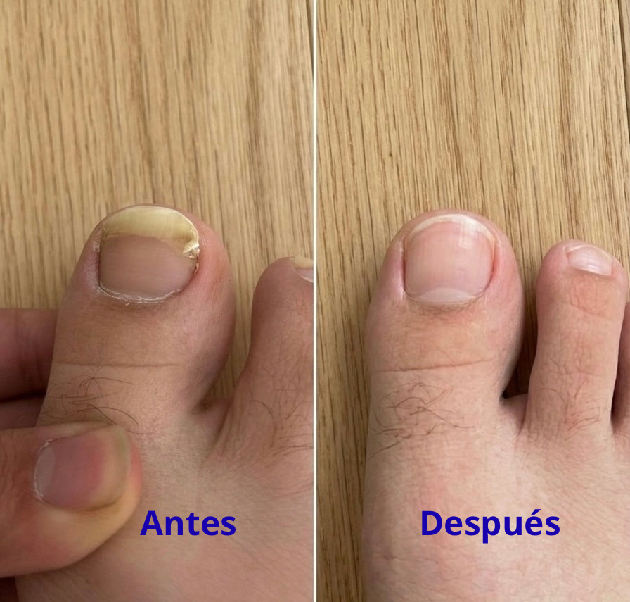 Elimina Hongos en las Uñas - Tratamiento Antihongos para Uñas y Pies