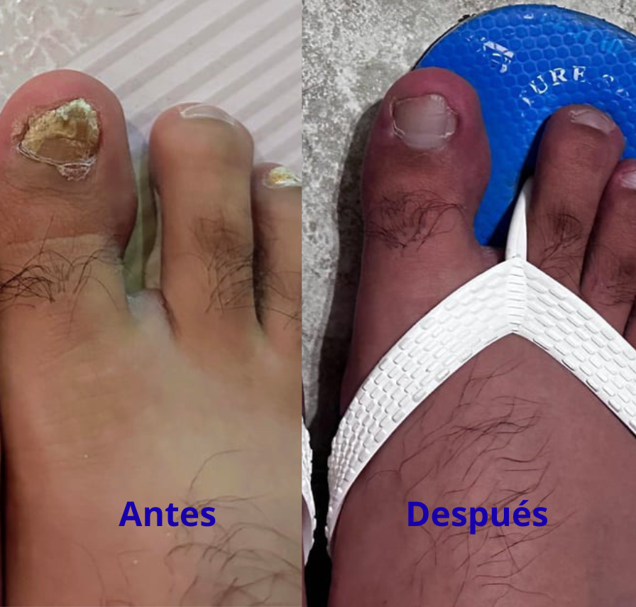 Elimina Hongos en las Uñas - Tratamiento Antihongos para Uñas y Pies